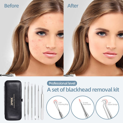 JPNK Blackhead Remover Comedone Extractor Acne Removal Kit..