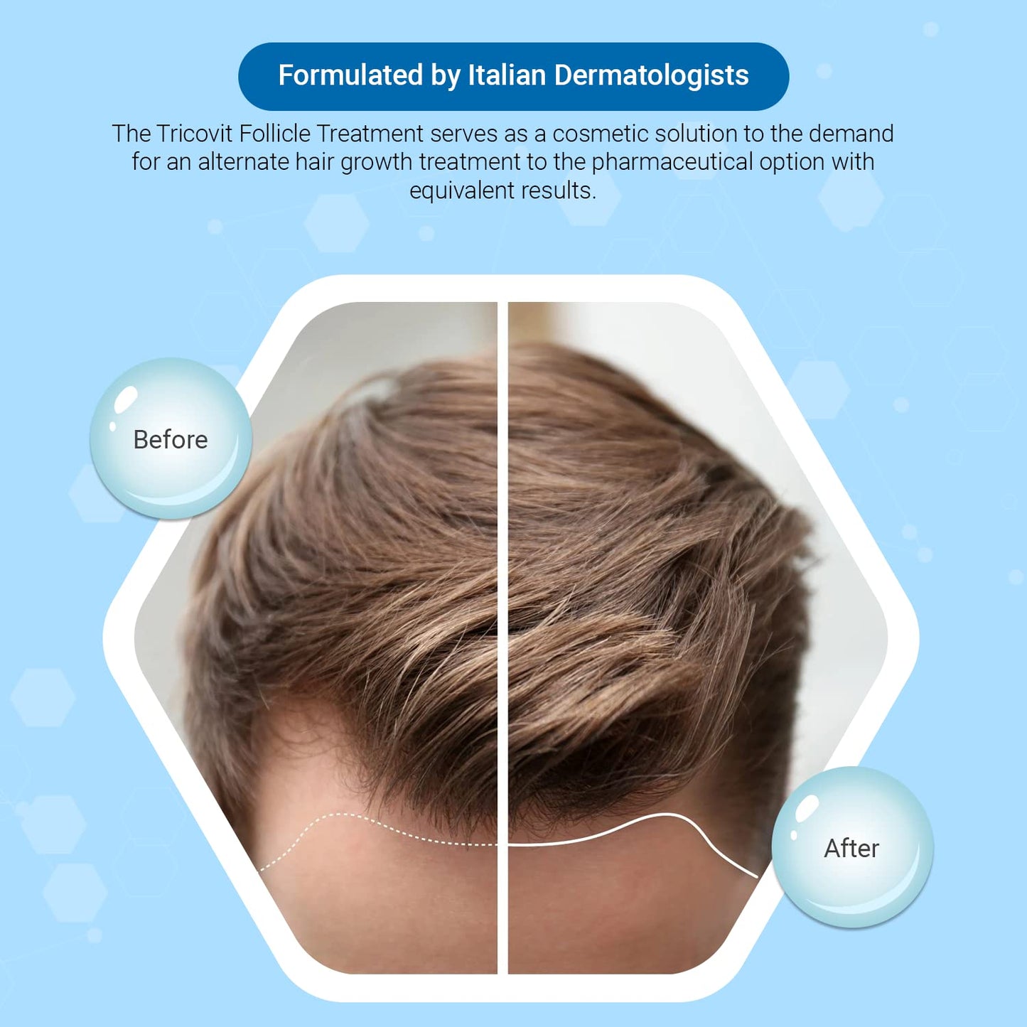 Tricovit Hormonal Emergency Kit - 1 Pro Hair Nutrition & Growth Stimulant Hair Supplement (60 gels) & 1 Forte Hair Lotion with Androgen and DHT Blockers for Thinning Hair and Hair Loss (10 packs)